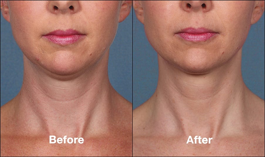 Get Rid of Your Double Chin with Kybella Specialists In New York